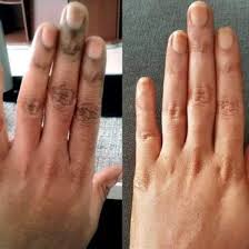 KNUCKLES CORRECTOR CREAM